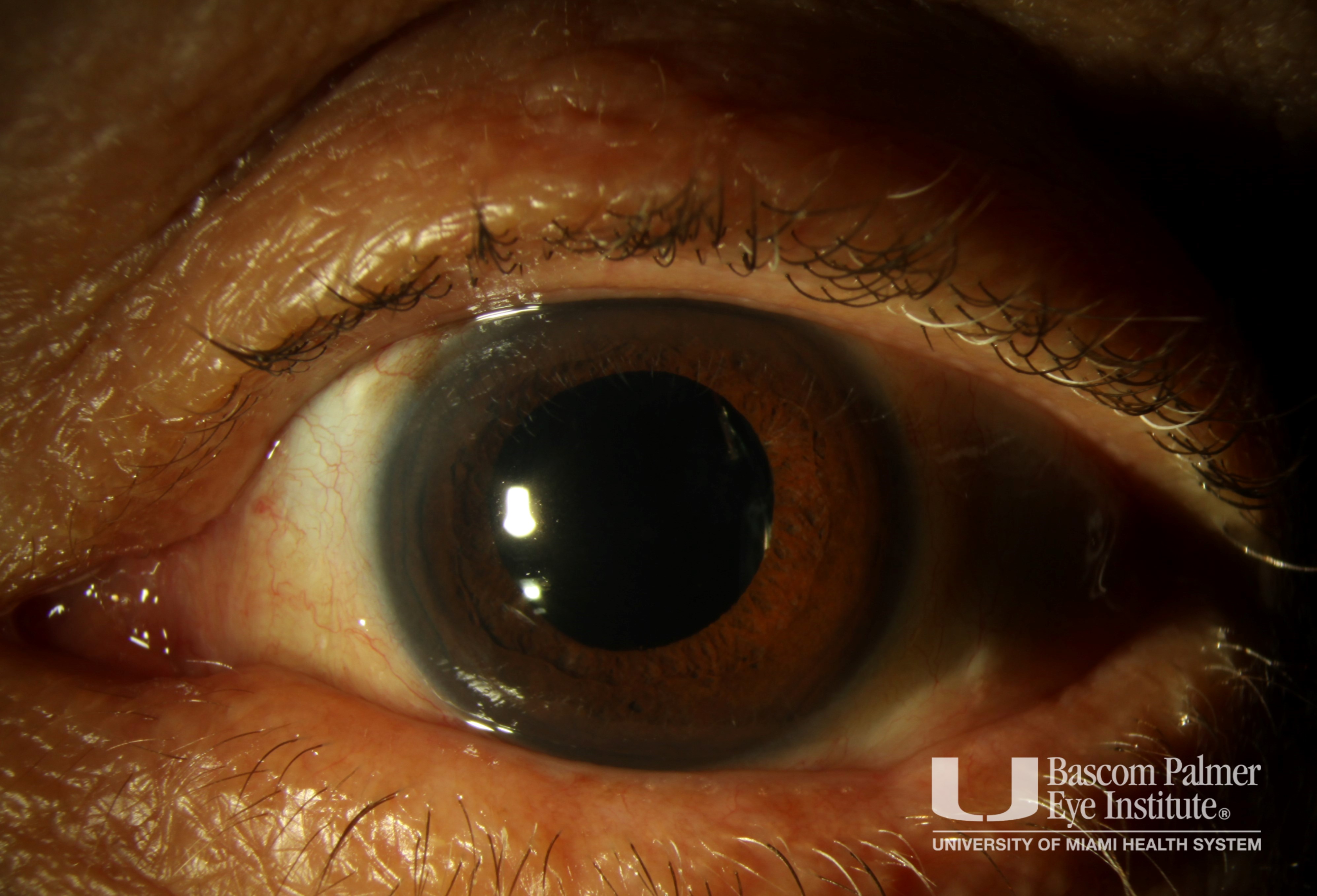 Course Extruded Scleral Buckle with Scleritis
